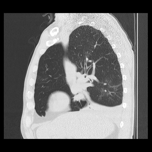 Allergic bronchopulmonary aspergillosis (ABPA) (Radiopaedia 60594-68313 Sagittal lung window 39).jpg