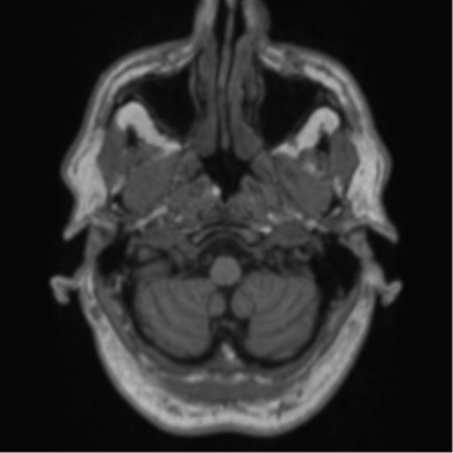 Alzheimer's disease- with Gerstmann syndrome and dressing apraxia (Radiopaedia 54882-61150 Axial T1 7).png
