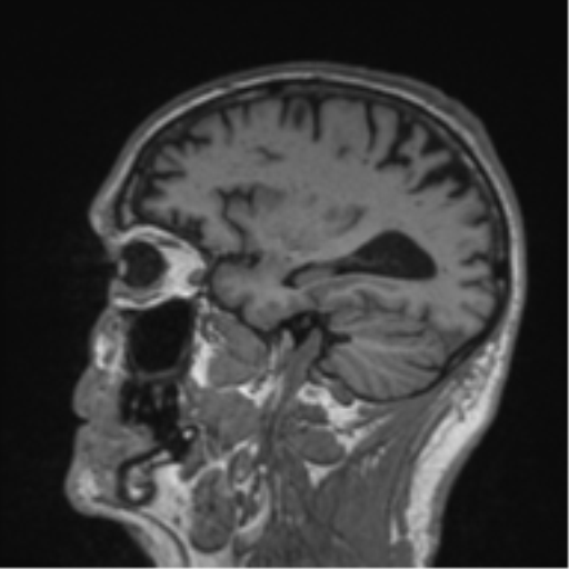 Alzheimer's disease- with Gerstmann syndrome and dressing apraxia (Radiopaedia 54882-61150 Sagittal T1 19).png