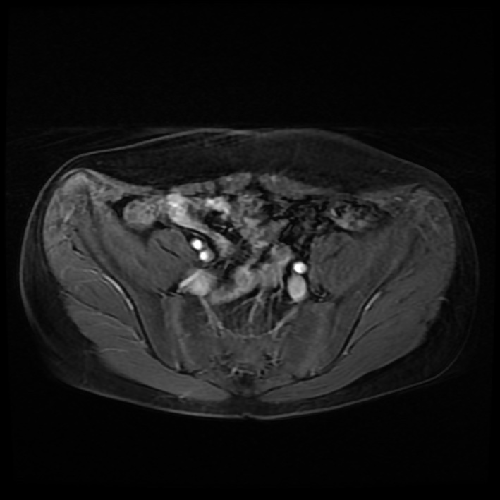 Ambiguous genitalia (Radiopaedia 69686-79643 Axial T1 C+ fat sat 9).jpg