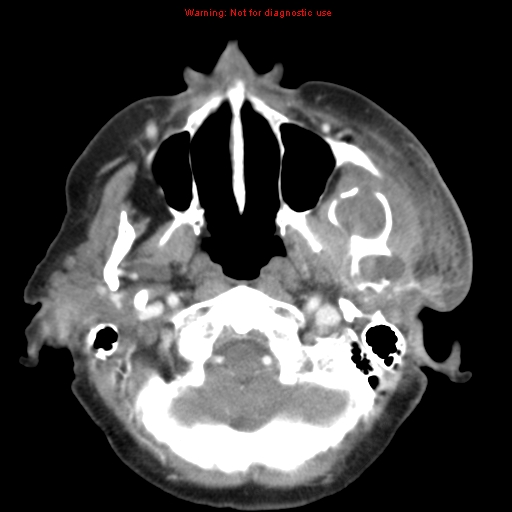 Ameloblastoma (Radiopaedia 27437-27631 A 21).jpg