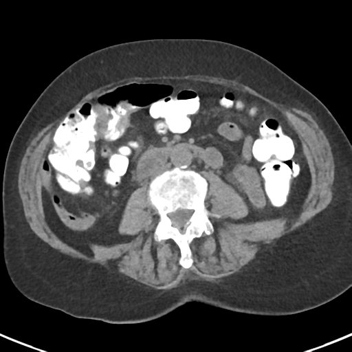 File:Ampullary adenocarcinoma (Radiopaedia 34013-35237 Axial non-contrast 33).png