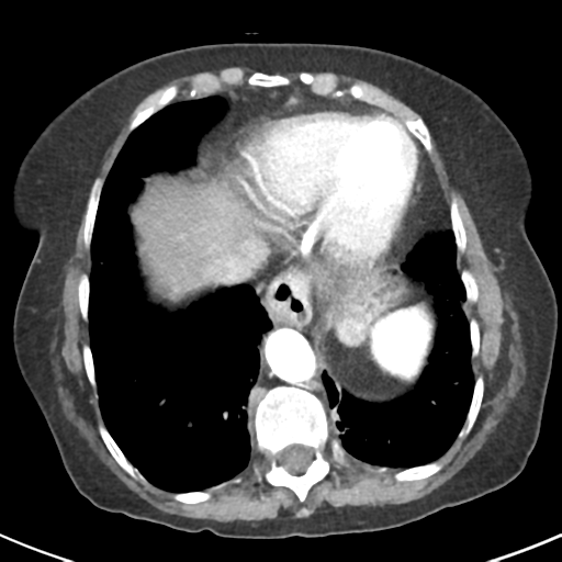 File:Ampullary adenocarcinoma (Radiopaedia 34013-35237 B 7).png