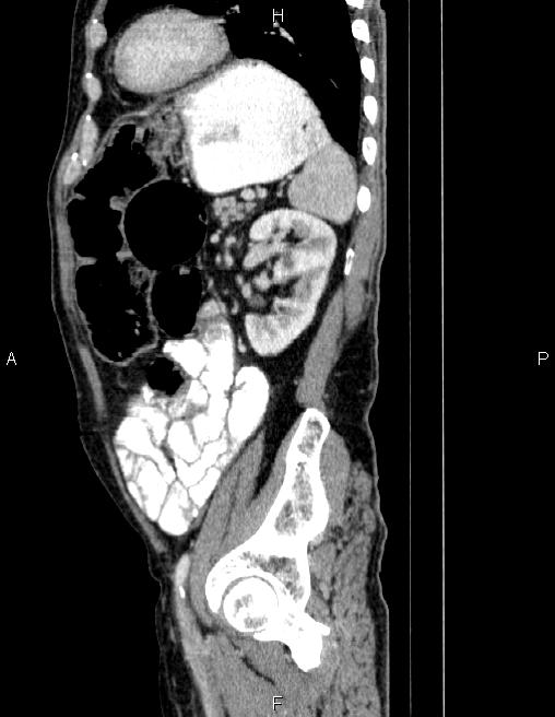 Ampullary adenocarcinoma (Radiopaedia 86093-102032 D 72).jpg