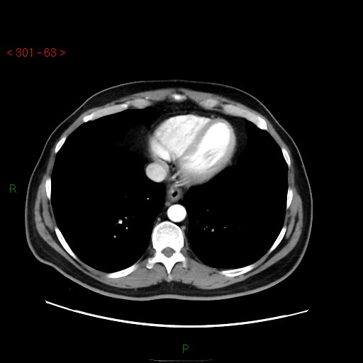 File:Ampullary carcinoma (Radiopaedia 56396-63056 B 9).jpg