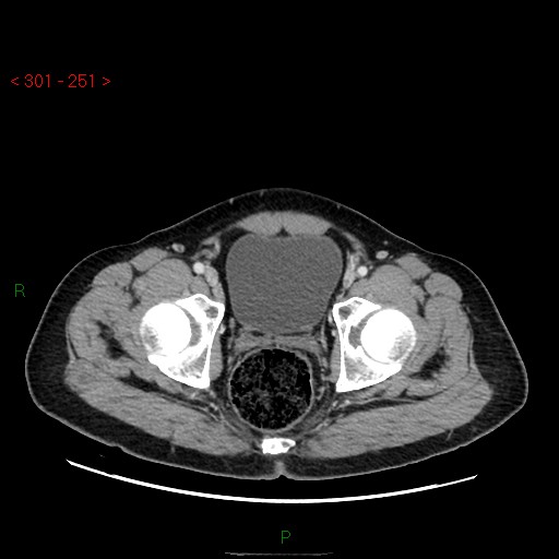File:Ampullary carcinoma (Radiopaedia 56396-63056 C 95).jpg