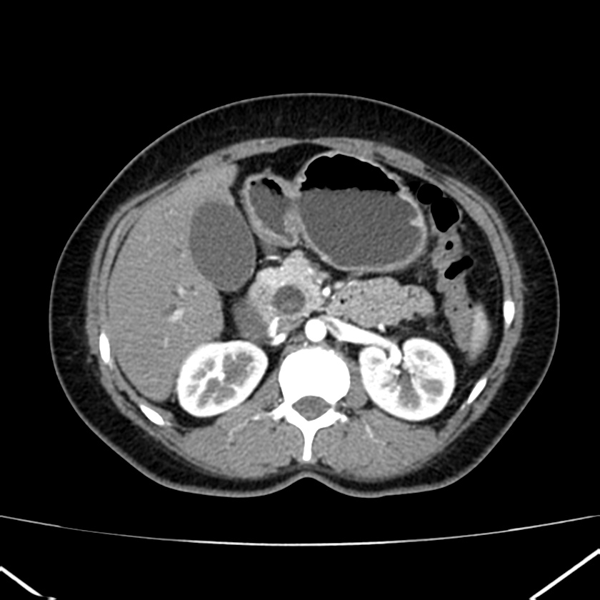 Ampullary tumor (Radiopaedia 22787-22816 B 34).jpg