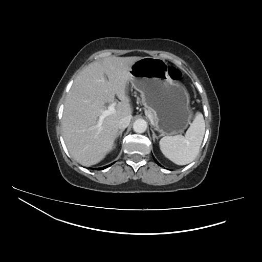 File:Ampullary tumor (Radiopaedia 60333-67998 A 17).jpg