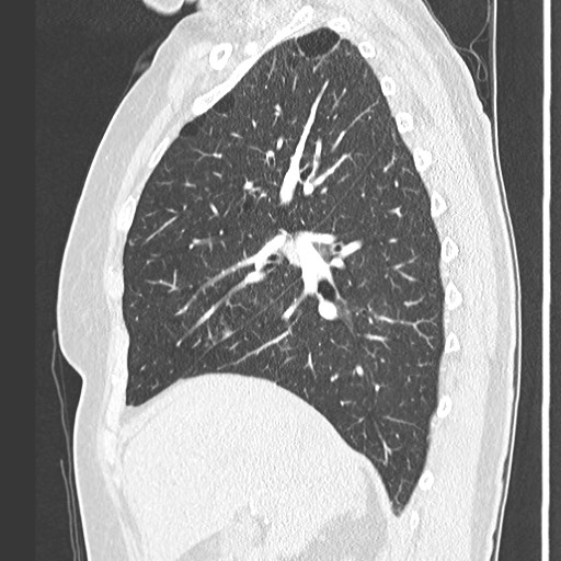 Amyloidosis - bronchial and diffuse nodular pulmonary involvement (Radiopaedia 60156-67745 Sagittal lung window 31).jpg