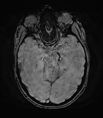 File:Anaplastic astrocytoma IDH mutant (Radiopaedia 50046-55341 Axial SWI 35).png