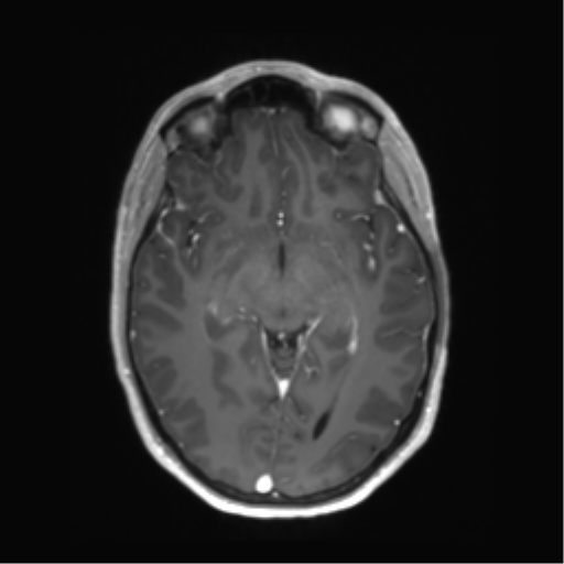 File:Anaplastic astrocytoma IDH mutant (Radiopaedia 50046-55341 Axial T1 C+ 23).png