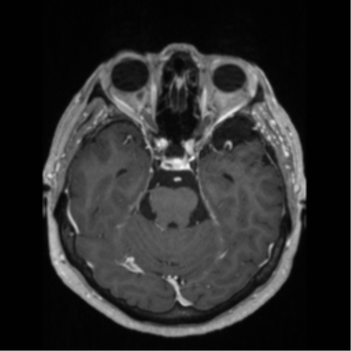 File:Anaplastic astrocytoma IDH wild-type (pseudoprogression) (Radiopaedia 42209-45276 Axial T1 C+ 56).png