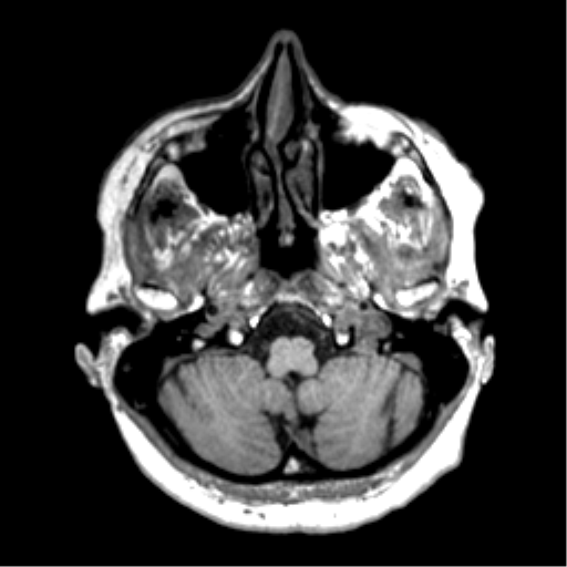 Anaplastic astrocytoma IDH wild-type (pseudoprogression) (Radiopaedia 42209-45277 Axial T1 20).png