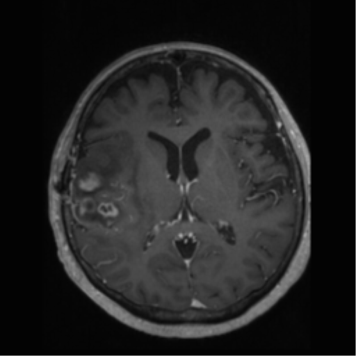 File:Anaplastic astrocytoma IDH wild-type (pseudoprogression) (Radiopaedia 42209-45277 Axial T1 C+ 68).png