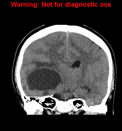 File:Anaplastic ganglioglioma (Radiopaedia 44921-48815 Coronal non-contrast 21).jpg