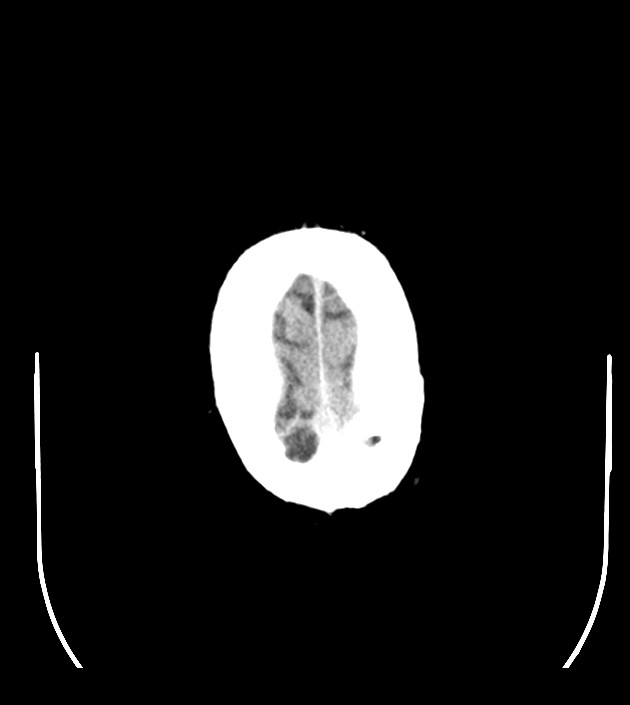 Anaplastic oligodendroglioma (Radiopaedia 79571-92755 Axial non-contrast 50).jpg