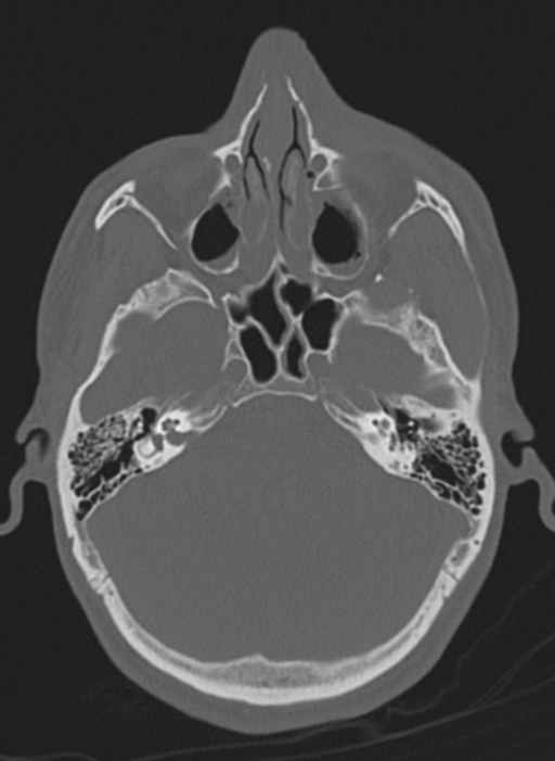 Anaplastic oligodendroglioma with skull fracture (Radiopaedia 74831-85846 Axial bone window 59).png