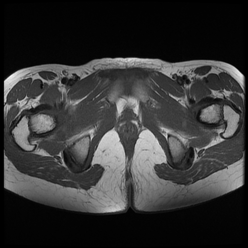 File:Androgen insensitivity syndrome (Radiopaedia 38585-40727 Axial T1 23).jpg