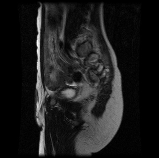 File:Aneurysmal bone cyst - sacrum (Radiopaedia 65190-74196 Sagittal T2 12).jpg