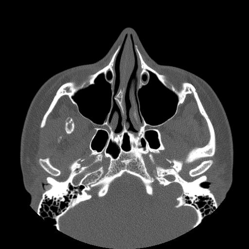 Aneurysmal bone cyst of the mandible (Radiopaedia 43280-46823 Axial bone window 139).jpg