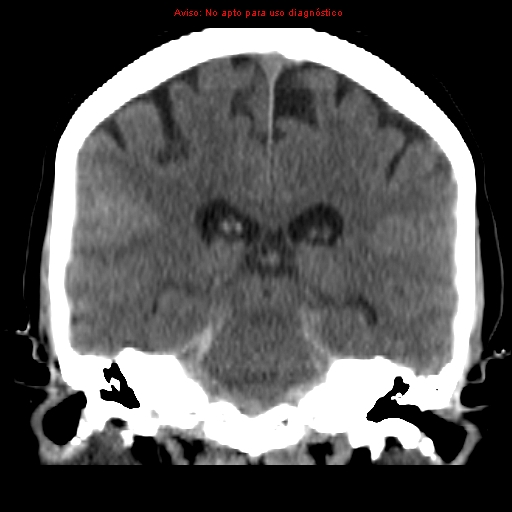 File:Aneurysmal subarachnoid hemorrhage (Radiopaedia 24740-24997 Coronal non-contrast 28).jpg