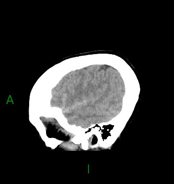 File:Aneurysmal subarachnoid hemorrhage with intra-axial extension (Radiopaedia 84371-99699 B 41).jpg