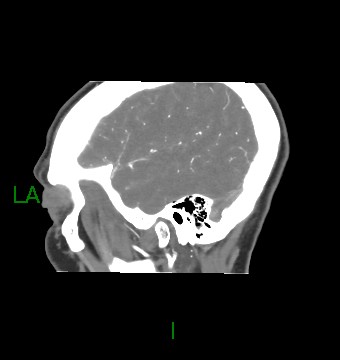 Aneurysmal subarachnoid hemorrhage with intra-axial extension (Radiopaedia 84371-99732 B 12).jpg