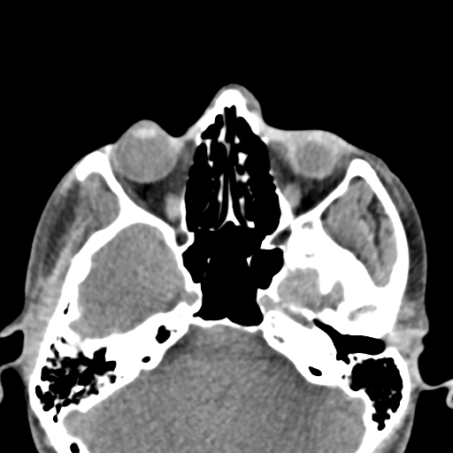 Angular dermoid cyst (Radiopaedia 88967-105790 Axial non-contrast 24).jpg