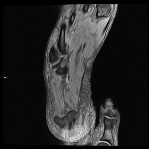 Ankle ganglion cyst (Radiopaedia 62809-71162 Axial Gradient Echo 3).jpg
