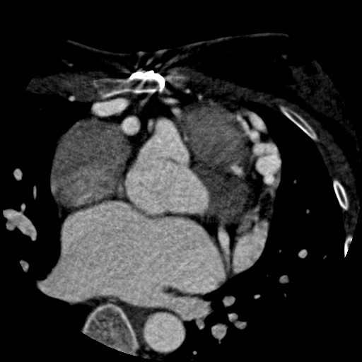 File:Anomalous left coronary artery from the pulmonary artery (ALCAPA) (Radiopaedia 40884-43586 A 27).jpg