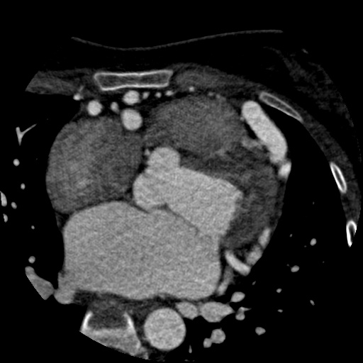 Anomalous left coronary artery from the pulmonary artery (ALCAPA) (Radiopaedia 40884-43586 A 33).jpg