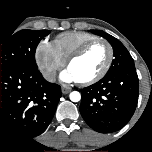 Anomalous left coronary artery from the pulmonary artery (ALCAPA) (Radiopaedia 70148-80181 A 238).jpg