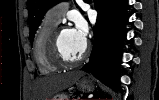 File:Anomalous left coronary artery from the pulmonary artery (ALCAPA) (Radiopaedia 70148-80181 C 158).jpg