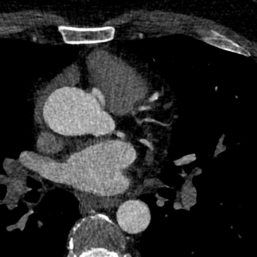 File:Anomalous origin of the left coronary artery with malignant course (Radiopaedia 77842-90126 C 36).jpeg