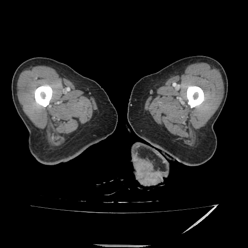 Anorectal carcinoma (Radiopaedia 44413-48064 A 73).jpg
