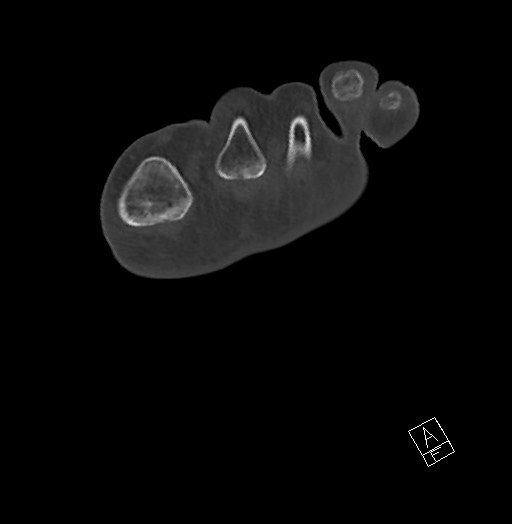 Anterior calcaneal process fracture (Radiopaedia 63353-71943 Axial bone window 35).jpg