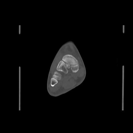 File:Anterior calcaneal process fracture (Radiopaedia 82590-96762 Coronal bone window 43).jpg