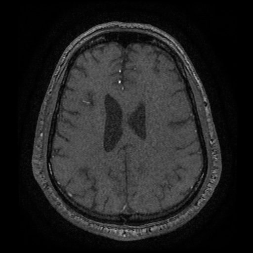 Anterior cerebral artery infarction (Radiopaedia 46794-51323 Axial MRA 157).jpg
