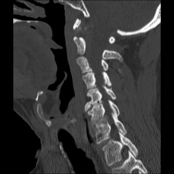 Anterior cervical postdiscectomy arthrodesis (Radiopaedia 32678-33646 Sagittal bone window 29).jpg