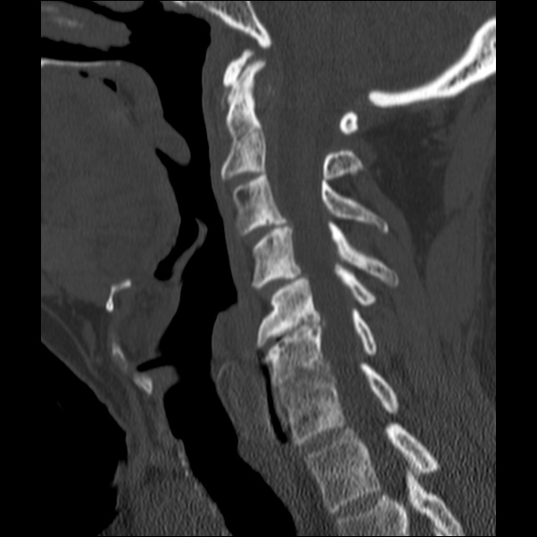 Anterior cervical postdiscectomy arthrodesis (Radiopaedia 32678-33646 Sagittal bone window 32).jpg