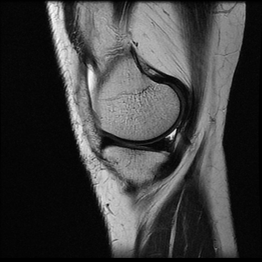 File:Anterior cruciate ligament avulsion fracture (Radiopaedia 58939-66193 Sagittal T2 17).jpg