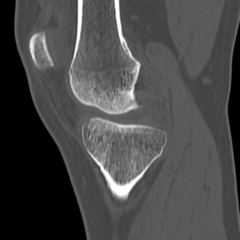 File:Anterior cruciate ligament avulsion fracture (Radiopaedia 58939-66194 Sagittal bone window 27).jpg