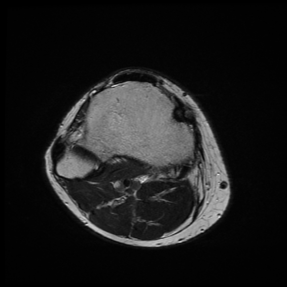 File:Anterior cruciate ligament graft tear and bucket-handle tear of medial meniscus (Radiopaedia 75867-87254 Axial T2 3).jpg