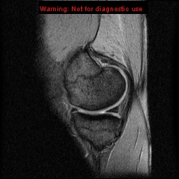 File:Anterior cruciate ligament injury - partial thickness tear (Radiopaedia 12176-12515 A 5).jpg
