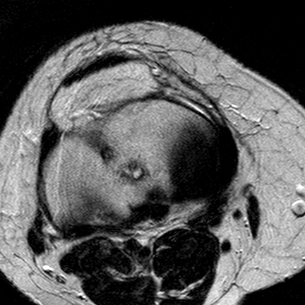 File:Anterior cruciate ligament mucoid degeneration (Radiopaedia 60853-68633 Axial T2 12).jpg