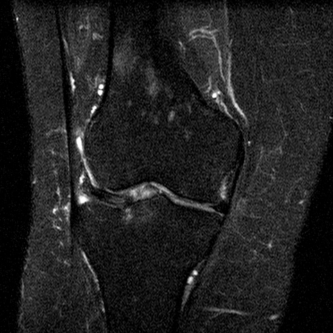 File:Anterior cruciate ligament mucoid degeneration (Radiopaedia 60853-68633 Coronal STIR 17).jpg
