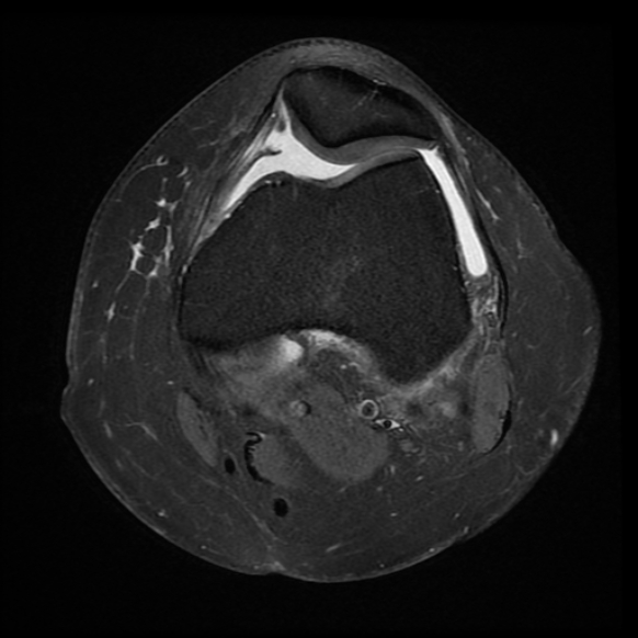 File:Anterior cruciate ligament tear, Wrisberg rip and bucket-handle tear of medial meniscus (Radiopaedia 75872-87266 Axial PD fat sat 19).jpg