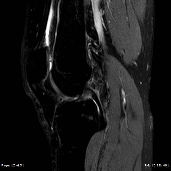 File:Anterior cruciate ligament tear (Radiopaedia 70783-80964 Sagittal STIR 15).jpg