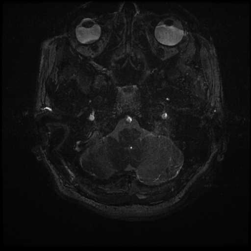 Anterior inferior cerebellar artery vascular loop - type II (Radiopaedia 70991-81209 Axial 3D FIESTA 76).jpg