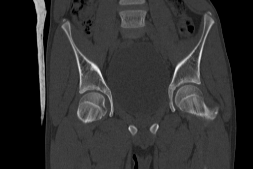 Anterior inferior iliac spine avulsion injury (Radiopaedia 88666-105376 Coronal bone window 32).jpg